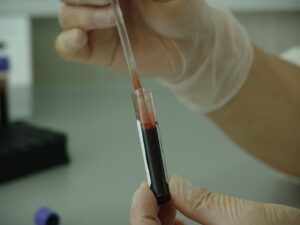 Dieci anni senza leucemia: la terapia CAR-T salva due pazienti