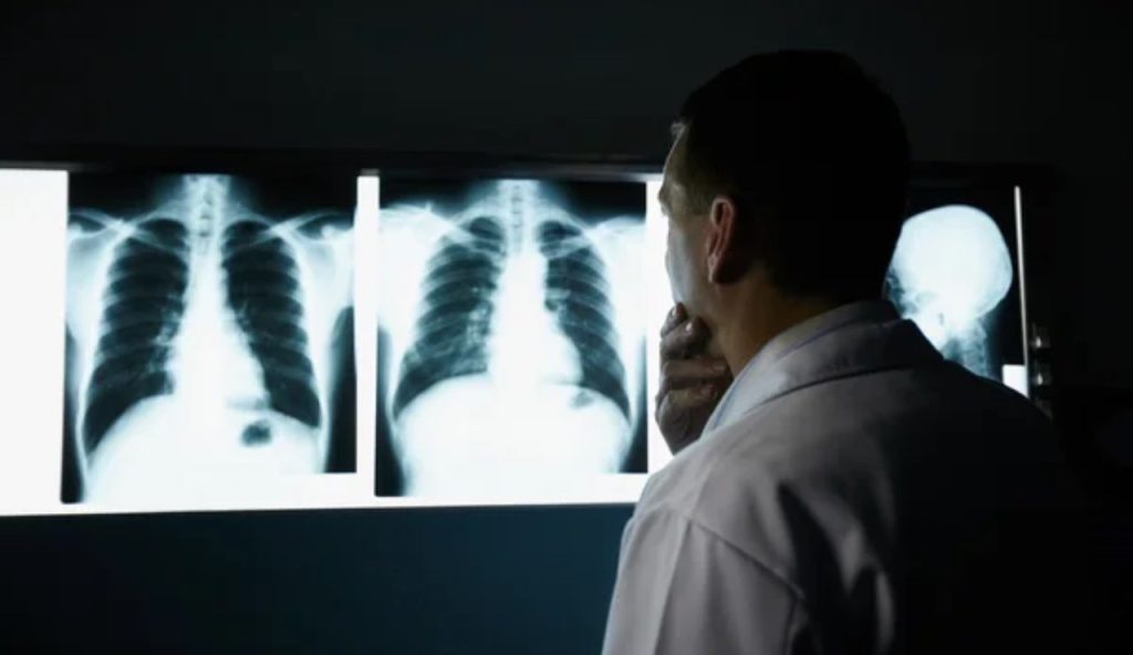 Valutazione cancro polmonare