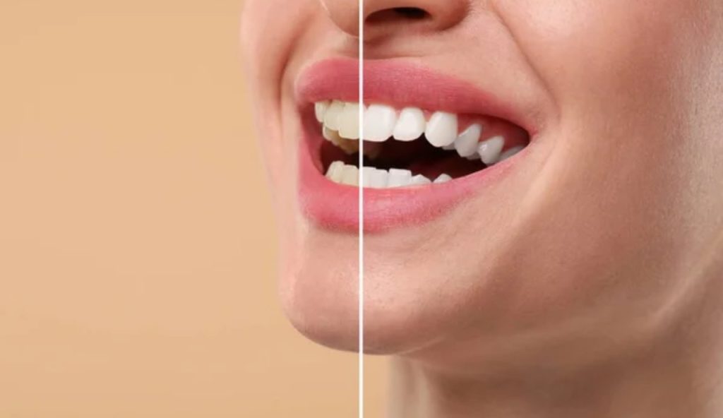 Avere denti bianchi