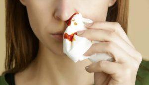 Uscita di sangue dal naso (Depositphotos foto) - www.biomedicalcue.it