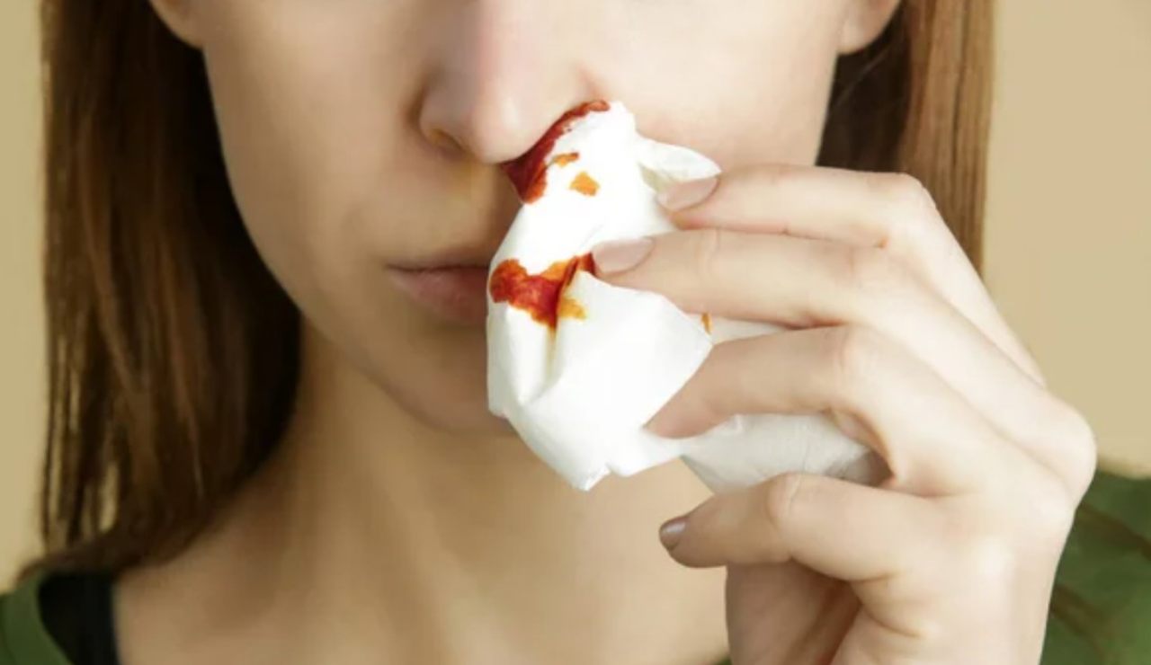 Sangue Dal Naso Narice Sinistra E Mal Di Testa