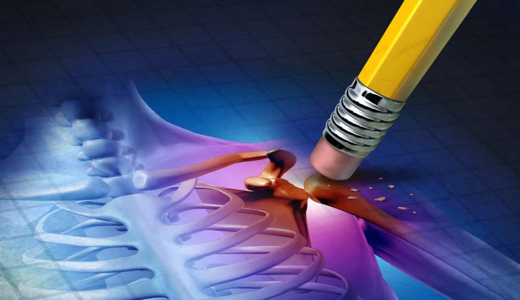 osteoporosi rappresentata dalla cancellazione dell'osso